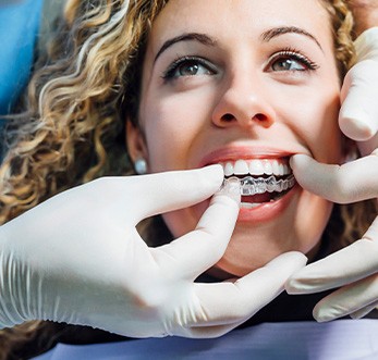 Dentist placing Invisalign over woman’s upper arch