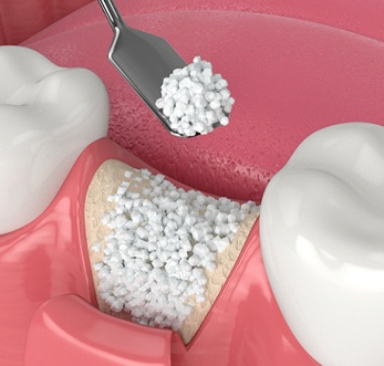 Animated smile during bone grafting in Mt. Pleasant