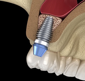 Animated smile during sinus lift in Mt. Pleasant