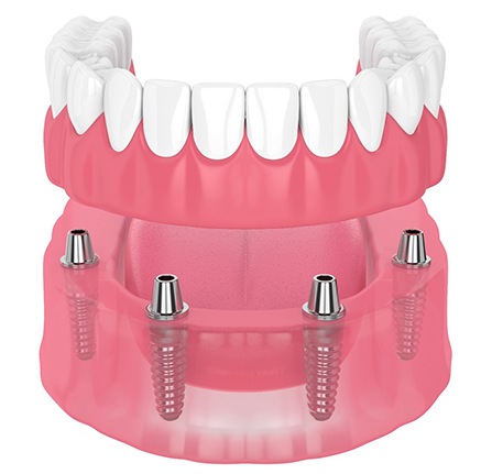 3D image of All-on-4 dental implants