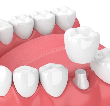 Illustration of a CEREC dental crown