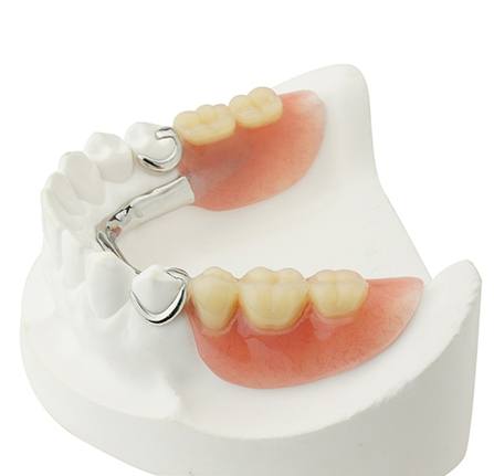 Partial dentures fit to a dental model