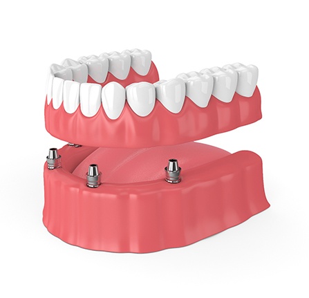 3D model of implant dentures
