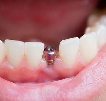 patient with dental implant in mouth 