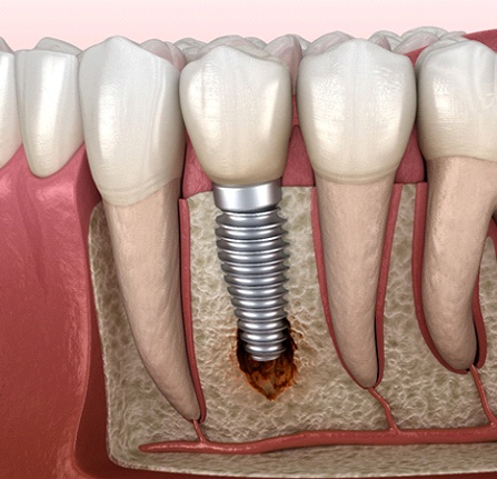 Illustration of peri-implantitis, a common cause of dental implant failure