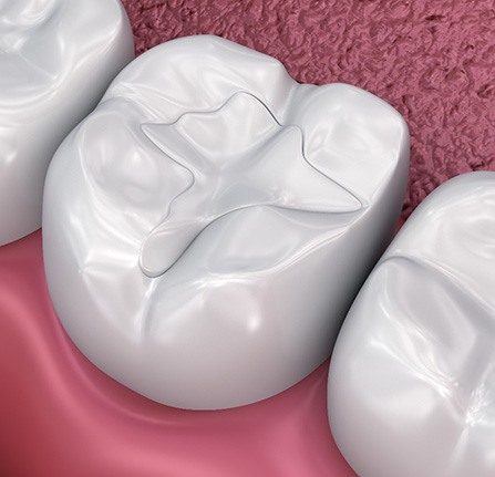 Render of tooth-colored fillings in Mt. Pleasant, WI for lower arch