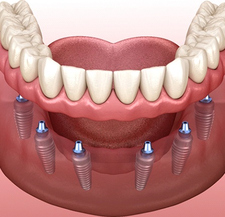 Implant dentures work in Milwaukee