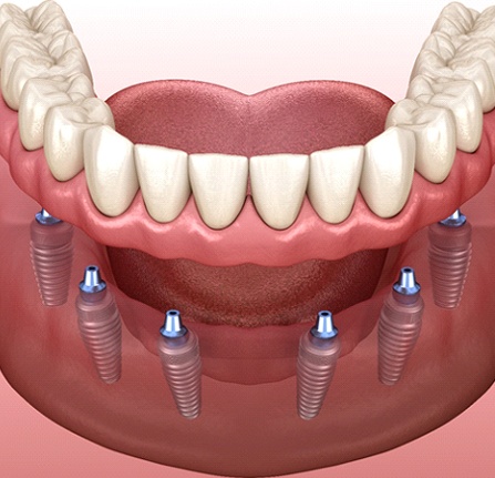 Animated smile during implant dentures placement in Mt. Pleasant