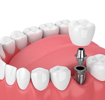 Animated smile during dental implant supported dental crown placement