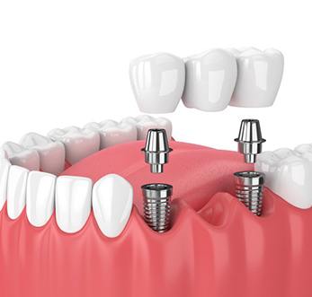 dental bridge on top of two dental implants