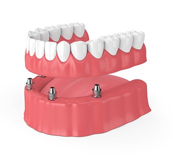 full denture on top of four dental implants