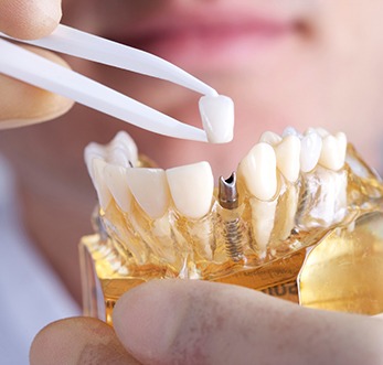 dentist placing a crown on top of a dental implant model