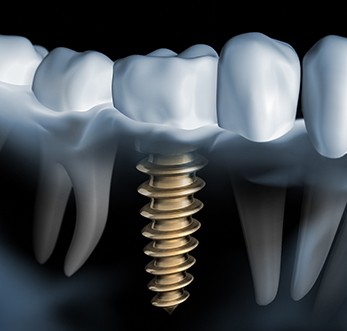 X-ray of a patient with a dental implant