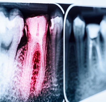 X-ray of an infected tooth that needs root canal therapy