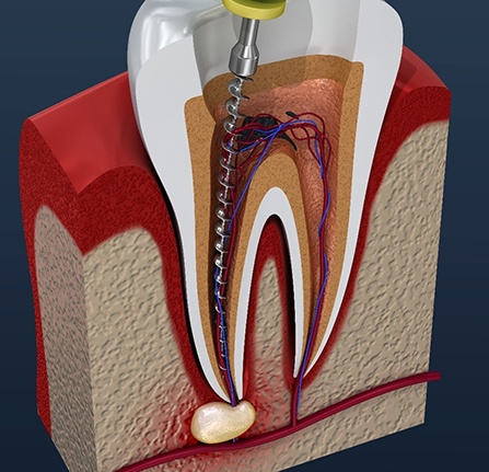 Animated smile during root canal procedure