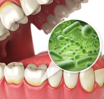  a graphic illustration showing bacteria within a mouth