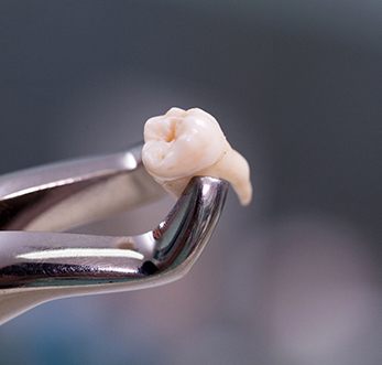 a pair of dental forceps holding an extracted tooth