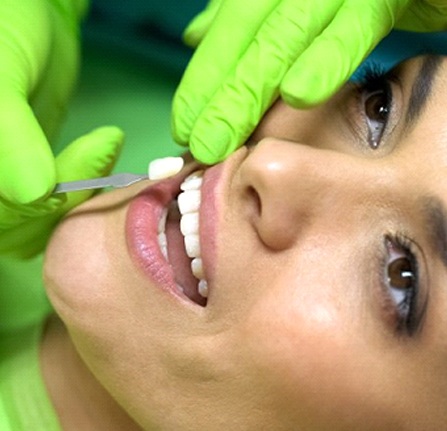 Dentist placing a porcelain veneer over a patient’s tooth