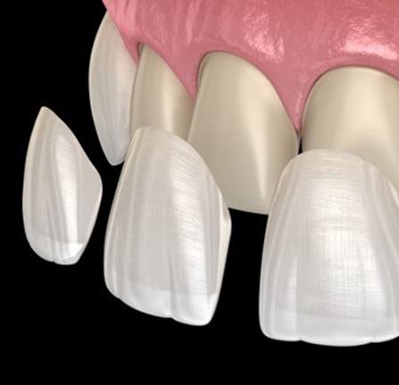 Animated smile with porcelain veneers being placed over several upper teeth