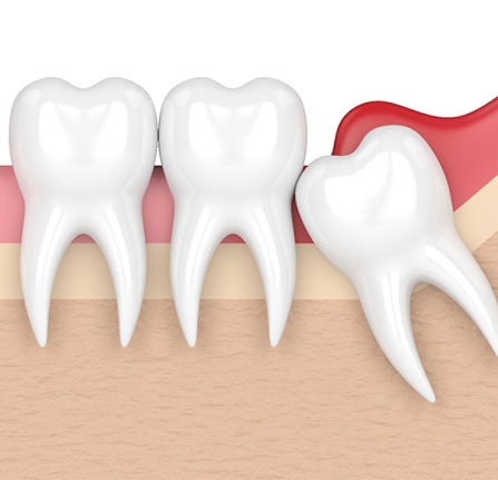 Impacted wisdom tooth graphic