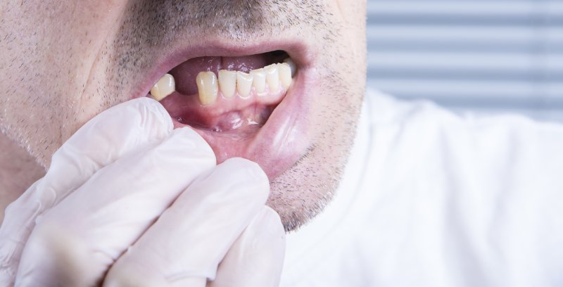 Person with knocked-out tooth