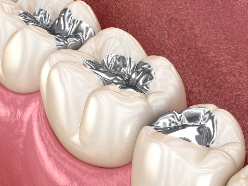 Close-up of metal fillings