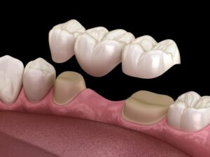 Dental bridge. 